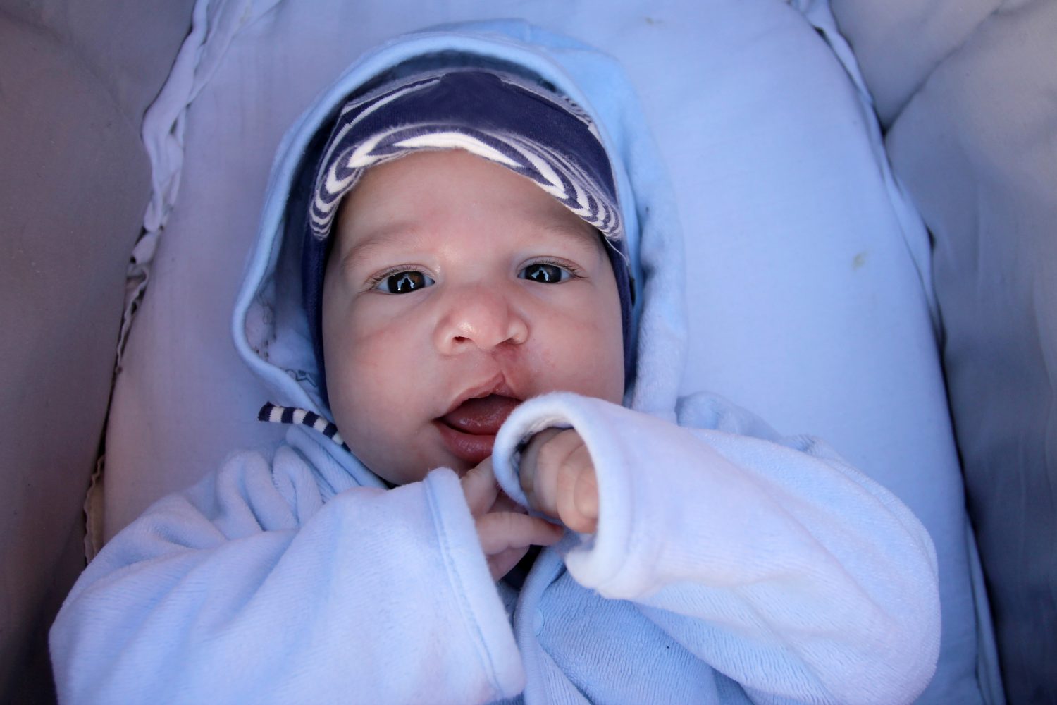 CLEFT-Q | Q-Portfolio - MEASURING WHAT MATTERS TO PATIENTS